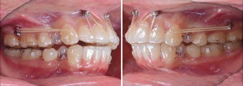 Bimaxillary Protrusion And Gummy Smile Treated With Clear Aligners