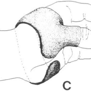 Tenodesis splints (TS). (A) Taping. (B) Heidleberg splint. (C) Volar... | Download Scientific ...