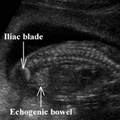 Fetal Echogenic Bowel By Dr Chapas Clinical Pearls