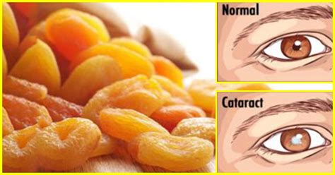 10 Effective Home Remedies For Cataracts