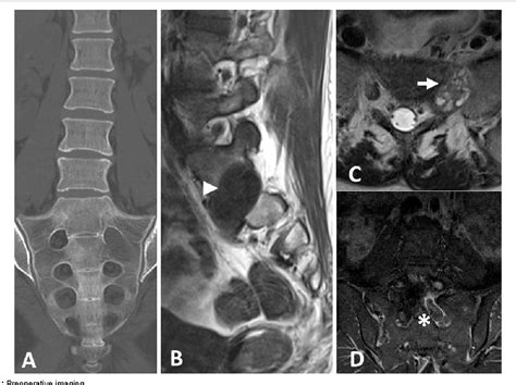 Figure 1 From Primary Extradural Peripheral Primitive Neuroectodermal