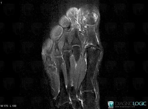 Radiology Case Degenerative Joint Disease Mri Diagnologic