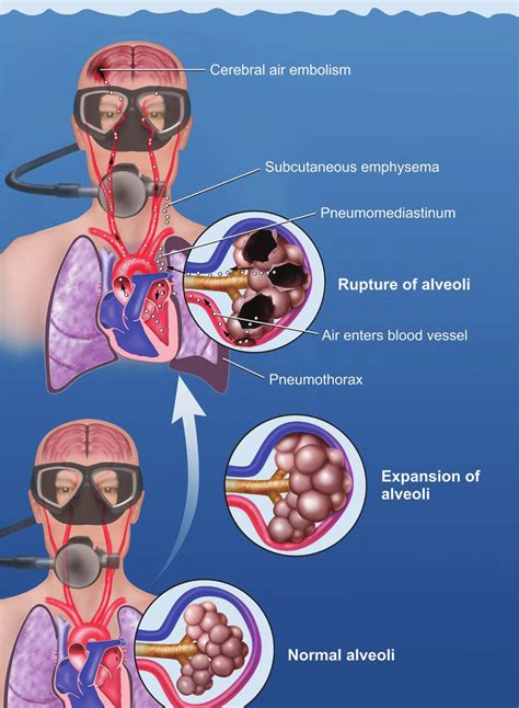 Mechanism Of Pulmonary Barotrauma In A Diver Breathing Compressed Gas