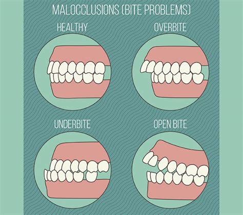 Malocclusions Precision Orthodontics And Pediatric Dentistry Reston Va 20191