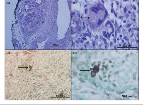 Figure 1 from Infection caused by the yeast form of Paracoccidioides brasiliensis | Semantic Scholar