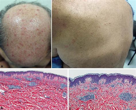 A Folliculotropic Mycosis Fungoides Of The Scalp Left And Left Trunk