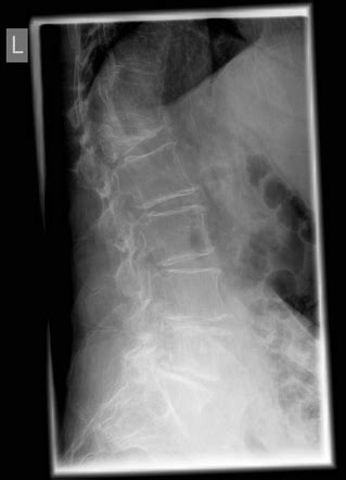 Vertebra plana | Radiology Case | Radiopaedia.org