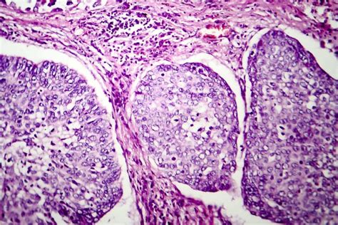 Lung Adenocarcinoma Light Micrograph Stock Illustration Illustration