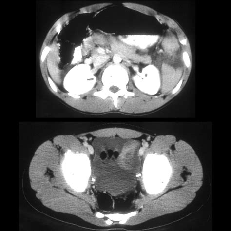 Pediatric Splenic Trauma Pediatric Radiology Reference Article