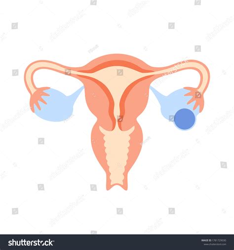 Ovarian Cyst Uterus Flat Vector Illustration Vetor Stock Livre De