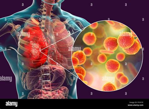 La Neumon A Causada Por La Bacteria Mycoplasma Pneumoniae Equipo