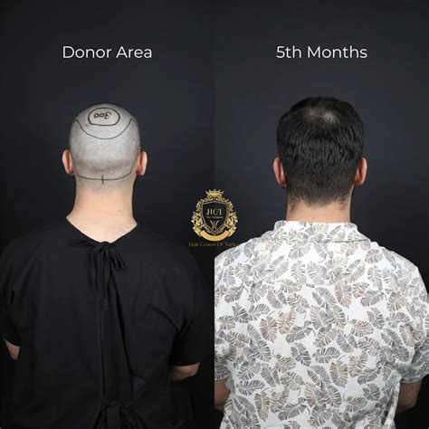 What Does The Donor Area Look Like After Hair Transplant