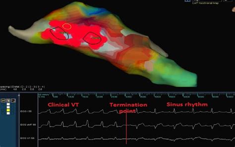 Three Dimension Electroanatomical Mapping Of The Left Ventricle Notes