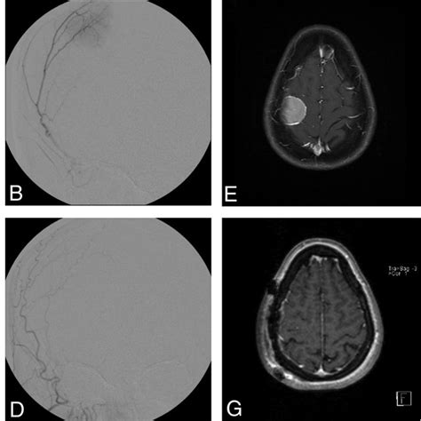 Pdf Preoperative Embolization Of Intracranial Meningiomas Efficacy