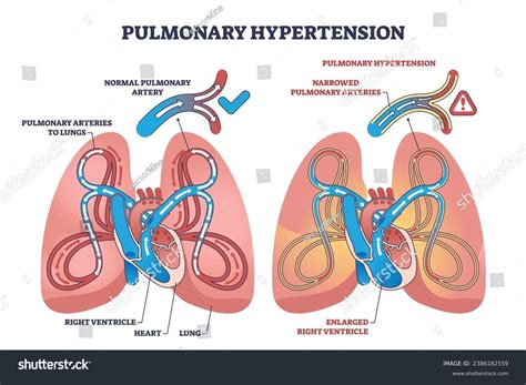 Pulmonary Hypertension Narrow Arteries Blockage Outline Stock Vector Royalty Free 2386182559