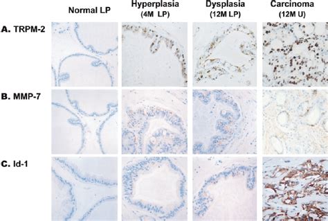 Immunohistochemical Study Of Trpm Mmp And Id Protein Expression