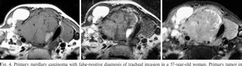 Figure From Differentiated Thyroid Carcinomas Prediction Of Tumor