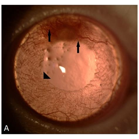 Histopathologic Photographs Of Cornea After Chemical Burn A Normal