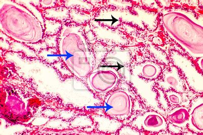 Hiperplasia Da Pr Stata Fotomicrografia Mostrando Gl Ndulas Fotomural
