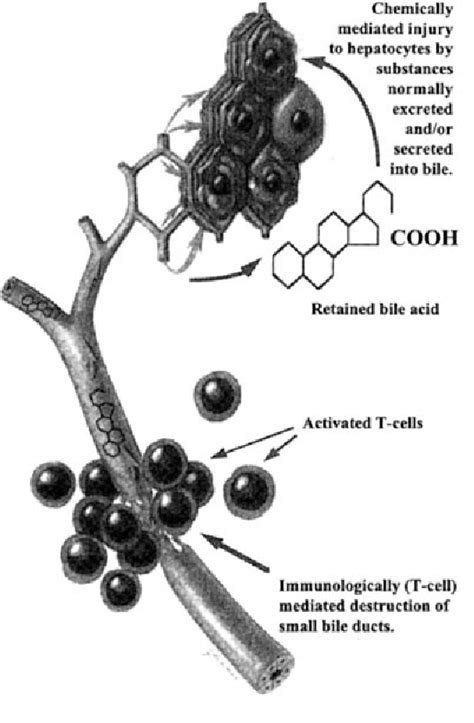 Figure 1 From Primary Biliary Cirrhosis Semantic Scholar