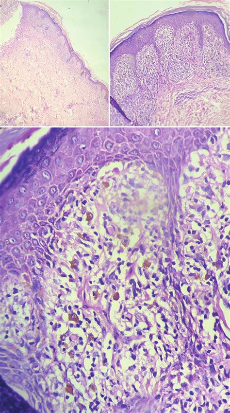 Irregular Epidermal Hyperplasia With Lymphocytic Infiltrate At