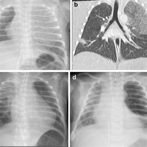 Congenital Pulmonary Airway Malformation Cpam In A Day Old Girl