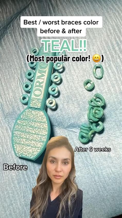 Best Braces Colors Teal Before And After Braces Braceson Bracescolors Artofit