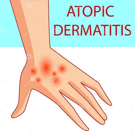 Atopic Dermatis The Person Scratches The Arm On Which Is Atopic