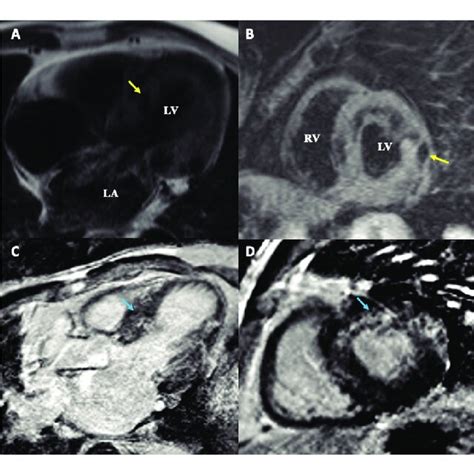 Cardiac Magnetic Resonance Imaging Cmr Cine Sequence Show Enlarged