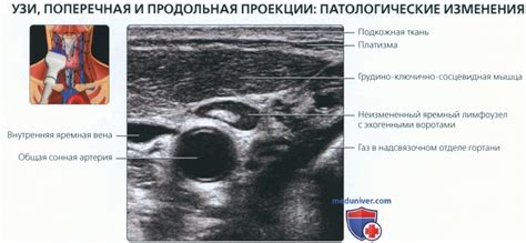 УЗИ анатомия лимфатических узлов шеи