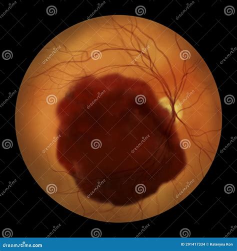 A Subretinal Hemorrhage As Observed During Ophthalmoscopy An