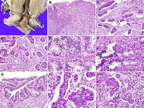 Pathological Features Of Invasive Micropapillary Carcinoma Of The Download Scientific Diagram