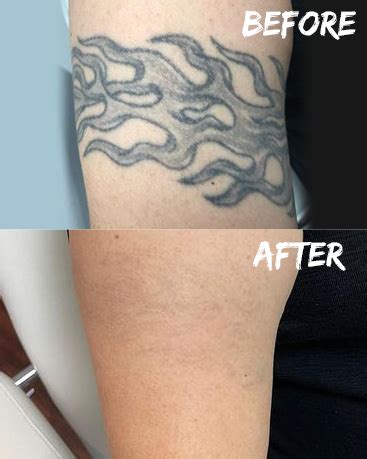 Pricing - Clear Out Ink | Laser Tattoo Removal Services Las Vegas, NV