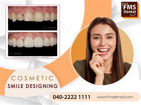 Digital Smile Designing Smile Makeover Clinic In Hyderabad India