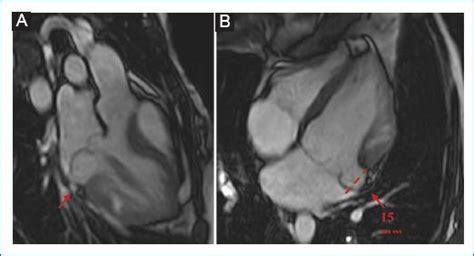 Disyunci N Del Anillo Mitral Como Marcador De Riesgo En Prolapso De