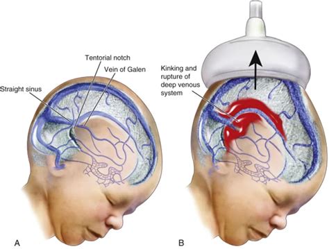 Intracranial Hemorrhage In Newborns Navigating Challenges With Expert