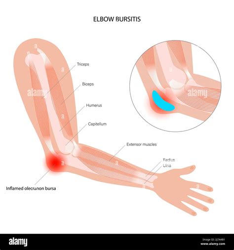 Elbow Bursitis Illustration Stock Photo Alamy