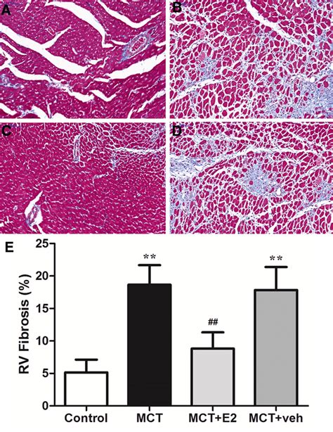 E2 Administration Reduced RV Fibrosis In Rats With MCT Induced PAH