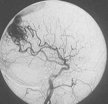 Malformacion Arteriovenosa Fleni