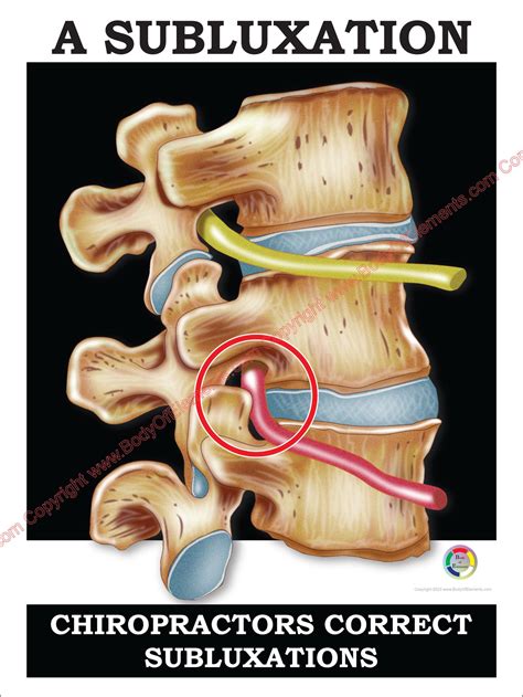 Chiropractors Correct Subluxations Poster – Body of Elements