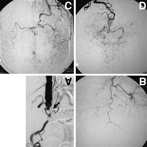 A Right Carotid Angiogram Showing Internal Carotid Artery Occlusion