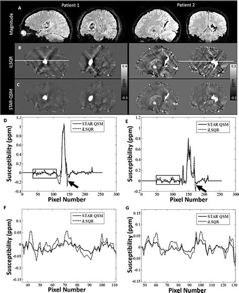 Comparison Of Quantitative Susceptibility Mapping QSM Reconstructed