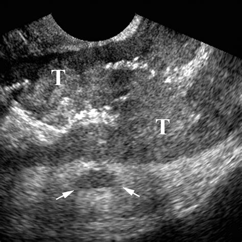 Transvaginal Sonography As An Adjunct To Endorectal Sonography In The Staging Of Rectal Cancer