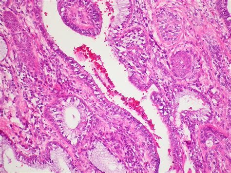Mucoepidermoid carcinoma, high grade Case 200 | Mucoepidermo… | Flickr