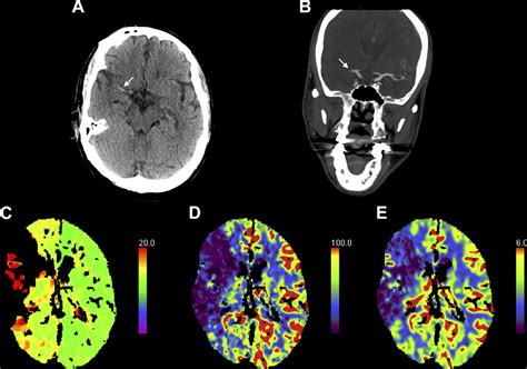 Interpreting Ct Perfusion In Stroke Practical Neurology