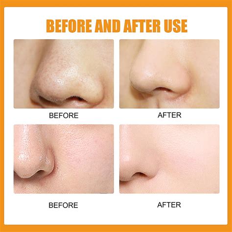 Patch Nose Pimple Patches Xl Hydrocolloid Patches For Nose Pores