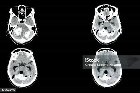 Ct Scan Otak Foto Stok Unduh Gambar Sekarang Anatomi Bagian Tubuh