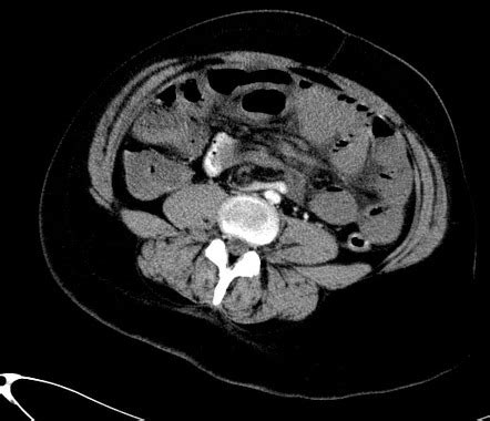 Midgut volvulus - ischemic | Radiology Case | Radiopaedia.org