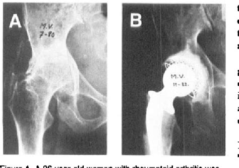 Figure From Bone Grafting In Total Hip Replacement For Acetabular