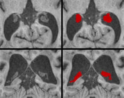 Assessing Choroid Plexus Pathology In Neurological Disease With